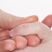 Warts